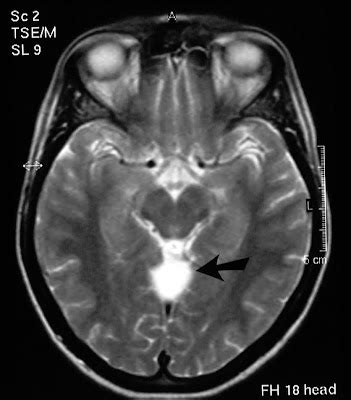 superior cerebellar cistern arachnoid cyst.